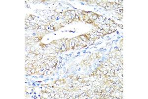 Immunohistochemistry of paraffin-embedded Human uterine cancer using IFN antibody (ABIN3015562, ABIN3015563, ABIN3015564 and ABIN6218872) at dilution of 1:100 (40x lens). (IFNAR2 anticorps  (AA 27-243))