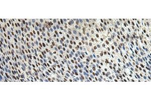 Immunohistochemistry of paraffin-embedded Human lung cancer tissue using DDX39A Polyclonal Antibody at dilution of 1:65(x200) (DDX39 anticorps)