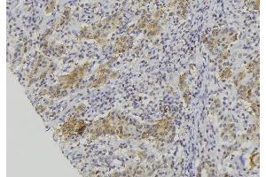 ABIN6273134 at 1/100 staining Human lung cancer tissue by IHC-P.