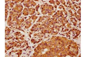 IHC image of ABIN7157587 diluted at 1:400 and staining in paraffin-embedded human pancreatic cancer performed on a Leica BondTM system. (KIF13A anticorps  (AA 1383-1537))