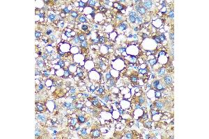 Immunohistochemistry of paraffin-embedded Human liver cancer using GMIP Rabbit pAb (ABIN7267369) at dilution of 1:100 (40x lens).