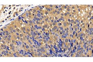 Detection of CASP7 in Human Breast cancer Tissue using Polyclonal Antibody to Caspase 7 (CASP7)