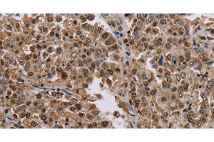 Immunohistochemistry of paraffin-embedded Human liver cancer tissue using MRGPRX1 Polyclonal Antibody at dilution 1:40 (MRGPRX1 anticorps)