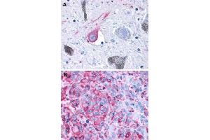 Immunohistochemical (Formalin/PFA-fixed paraffin-embedded sections) staining in human brain, substantia nigra (A) and human melanoma (B) with GPR50 polyclonal antibody . (GPR50 anticorps  (C-Term))