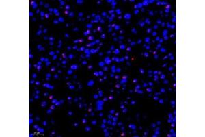Immunofluorescence of paraffin embedded human liver cancer using RBM8A (ABIN7075478) at dilution of 1: 300 (400x lens) (RBM8A anticorps)