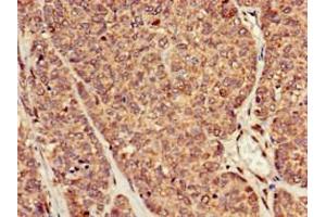 Immunohistochemistry of paraffin-embedded human ovarian cancer using ABIN7167819 at dilution of 1:100