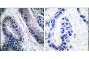Immunohistochemistry analysis of paraffin-embedded human lung carcinoma, using IL-1 beta (Cleaved-Asp210) Antibody. (IL-1 beta anticorps  (Cleaved-Asp210))