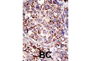 Formalin-fixed and paraffin-embedded human cancer tissue reacted with USP3 polyclonal antibody  , which was peroxidase-conjugated to the secondary antibody, followed by DAB staining. (USP3 anticorps  (C-Term))