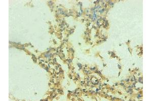 Immunohistochemical of paraffin-embedded human lung tissue using ABIN7168560 at dilution of 1:200 (S100A9 anticorps)