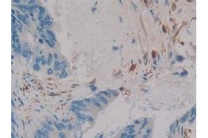 Detection of CR in Human Colorectal cancer Tissue using Polyclonal Antibody to Calretinin (CR)