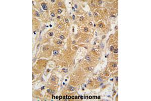 Formalin-fixed and paraffin-embedded human hepatocarcinomareacted with APOA5 polyclonal antibody , which was peroxidase-conjugated to the secondary antibody, followed by AEC staining. (APOA5 anticorps  (N-Term))
