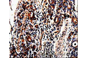 Immunohistochemistry of Human lung cancer using ACSBG2 Polyclonal Antibody at dilution of 1:60 (ACSBG2 anticorps)