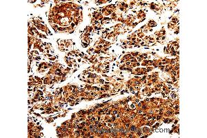 Immunohistochemistry of Human liver cancer using APLP1 Polyclonal Antibody at dilution of 1:25