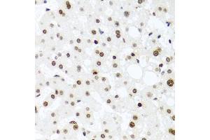Immunohistochemistry of paraffin-embedded human liver injury using H2AFX antibody (ABIN4903860) at dilution of 1:100 (40x lens). (H2AFX anticorps)