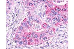 Anti-NPFF2 / NPFFR2 antibody IHC of human Pancreas, Carcinoma. (NPFFR2 anticorps  (Extracellular Domain))