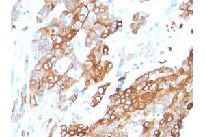 Formalin-fixed, paraffin-embedded human Breast Carcinoma stained with Heregulin-1 Mouse Monoclonal Antibody (NRG1/2710). (Neuregulin 1 anticorps  (AA 21-242))