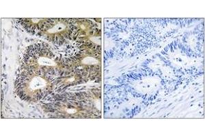 Immunohistochemistry analysis of paraffin-embedded human colon carcinoma, using TRAPPC6A Antibody. (TRAPPC6A anticorps  (AA 31-80))