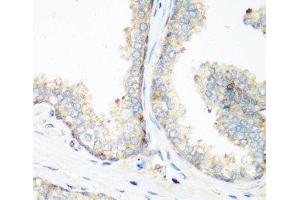 Immunohistochemistry of paraffin-embedded Human prostate using NEDD4 Polyclonal Antibody at dilution of 1:200 (40x lens). (NEDD4 anticorps)