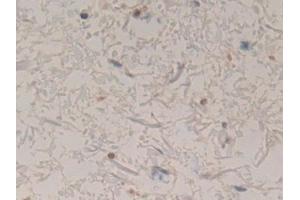 Detection of CORO1A in Human Stomach cancer Tissue using Polyclonal Antibody to Coronin 1A (CORO1A)