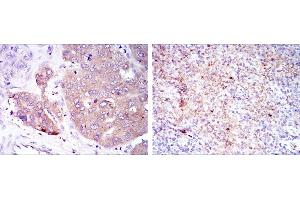 Immunohistochemical analysis of paraffin-embedded liver cancer (left) and submaxillary tumor (right) using EIF4E mouse mAb with DAB staining. (EIF4E anticorps)