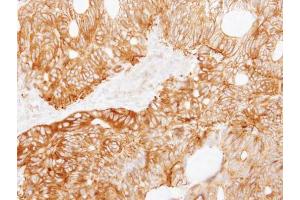 IHC-P Image Immunohistochemical analysis of paraffin-embedded human colon carcinoma, using Ladinin 1, antibody at 1:250 dilution. (Ladinin 1 anticorps  (C-Term))