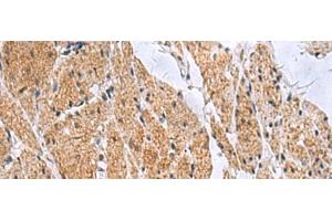 Immunohistochemistry of paraffin-embedded Human esophagus cancer tissue using SLC4A3 Polyclonal Antibody at dilution of 1:35(x200) (SLC4A3 anticorps)
