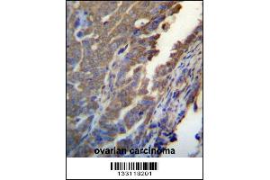 ASB4 Antibody immunohistochemistry analysis in formalin fixed and paraffin embedded human ovarian carcinoma followed by peroxidase conjugation of the secondary antibody and DAB staining. (ASB4 anticorps  (C-Term))