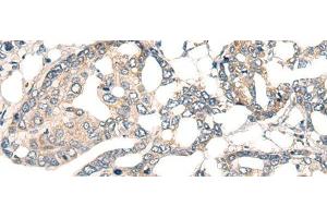 Immunohistochemistry of paraffin-embedded Human liver cancer tissue using CORO2A Polyclonal Antibody at dilution of 1:45(x200) (CORO2A anticorps)