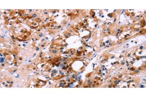 Immunohistochemistry of paraffin-embedded Human thyroid cancer using CALB1 Polyclonal Antibody at dilution of 1:60 (CALB1 anticorps)