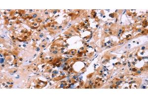 Immunohistochemistry of paraffin-embedded Human thyroid cancer using CALB1 Polyclonal Antibody at dilution of 1:60
