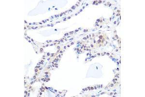 Immunohistochemistry of paraffin-embedded human thyroid cancer using DNA topoisomerase I (DNA topoisomerase I (TOP1)) Rabbit mAb (ABIN7270850) at dilution of 1:100 (40x lens).