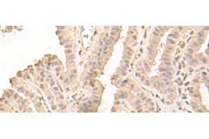 Immunohistochemistry of paraffin-embedded Human thyroid cancer tissue using SAP130 Polyclonal Antibody at dilution of 1:50(x200) (SAP130 anticorps)