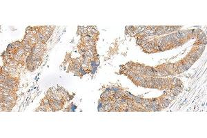 Immunohistochemistry of paraffin-embedded Human colorectal cancer tissue using SLC6A9 Polyclonal Antibody at dilution of 1:25(x200) (GLYT1 anticorps)
