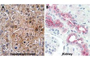 Formalin-fixed and paraffin-embedded human hepatocarcinoma (A) and human kidney (B) tissue reacted with BMPR2 polyclonal antibody , which was peroxidase-conjugated to the secondary antibody, followed by DAB staining. (BMPR2 anticorps  (AA 28-59))