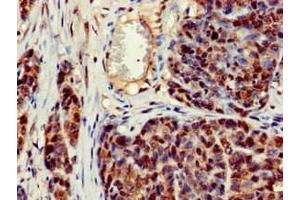 Immunohistochemistry of paraffin-embedded human ovarian cancer using ABIN7150470 at dilution of 1:100 (CRCP anticorps  (AA 1-115))
