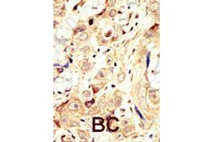 Formalin-fixed and paraffin-embedded human cancer tissue reacted with ERBB4 polyclonal antibody  , which was peroxidase-conjugated to the secondary antibody, followed by DAB staining. (ERBB4 anticorps  (N-Term))