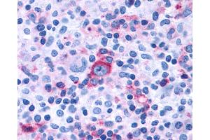 Anti-GPR97 antibody IHC of human Lymph Node, Hodgkins Lymphoma. (GPR97 anticorps  (Extracellular Domain))