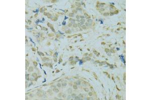 Immunohistochemistry of paraffin-embedded human breast cancer using SAFB antibody.