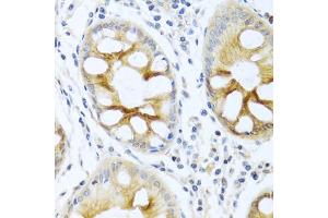 Immunohistochemistry of paraffin-embedded human colon using PRKCA antibody (ABIN5970097) at dilution of 1/100 (40x lens). (PKC alpha anticorps  (C-Term))