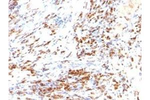 Formalin-fixed, paraffin-embedded human colon carcinoma stained with p27 antibody (DCS-72. (P27 anticorps)