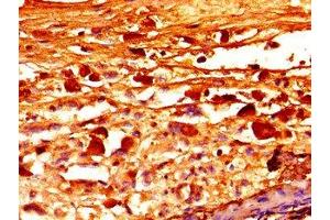 Immunohistochemistry of paraffin-embedded human melanoma using ABIN7152751 at dilution of 1:100 (Fibrillin 1 anticorps  (AA 783-850))