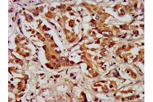 IHC image of ABIN7157898 diluted at 1:200 and staining in paraffin-embedded human liver cancer performed on a Leica BondTM system. (LAMC2 anticorps  (AA 417-588))