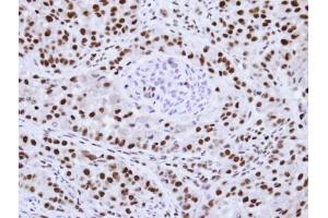 IHC-P Image Immunohistochemical analysis of paraffin-embedded A549 Xenograft , using hnRNP F , antibody at 1:100 dilution.