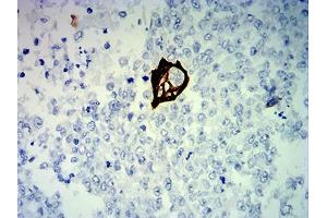 Immunohistochemical analysis of paraffin-embedded breast cancer tissues using KRT13 mouse mAb with DAB staining. (Cytokeratin 13 anticorps  (AA 104-458))