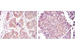 Immunohistochemical analysis of paraffin-embedded liver cancer tissues (left) and lung cancer tissues (right) using HIF1A mouse mAb with DAB staining. (HIF1A anticorps)