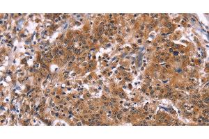 Immunohistochemistry of paraffin-embedded Human gastric cancer tissue using HACE1 Polyclonal Antibody at dilution 1:40 (HACE1 anticorps)