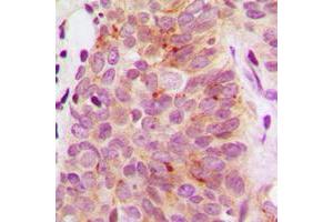 Immunohistochemical analysis of S6K1 staining in human breast cancer formalin fixed paraffin embedded tissue section.