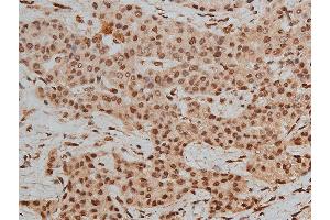 ABIN6267233 at 1/50 staining human liver cancer tissue sections by IHC-P.
