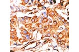 IHC analysis of FFPE human breast carcinoma stained with the Glycerol kinase antibody