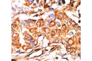 IHC analysis of FFPE human breast carcinoma stained with the Glycerol kinase antibody (GK2 anticorps  (AA 487-515))